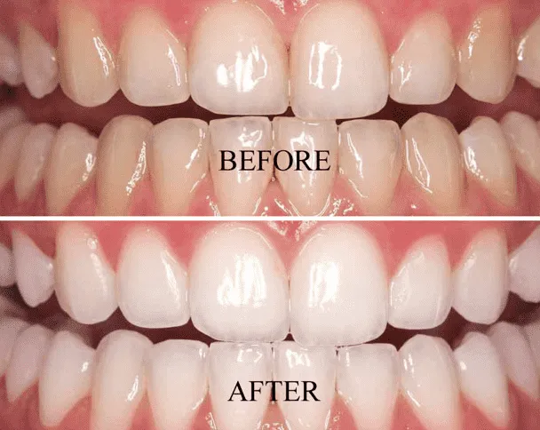 28303 teeth whitening westchester