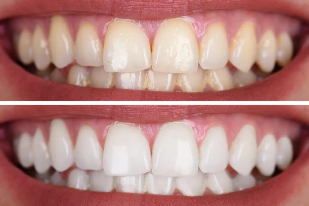 28305 customized whitening plan