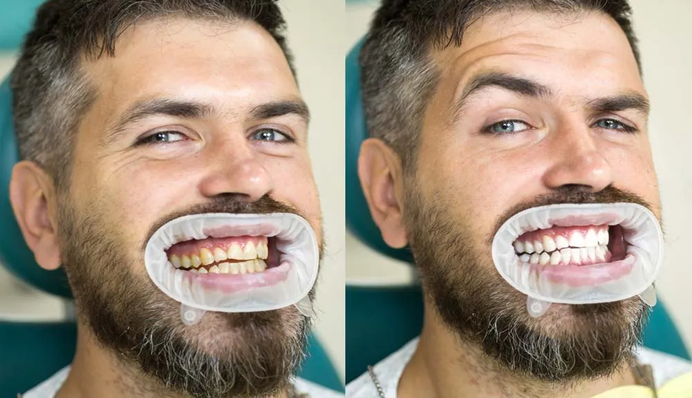 28305 dental professional whitening