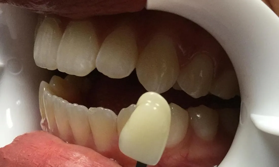 28305 teeth whitening maintenance