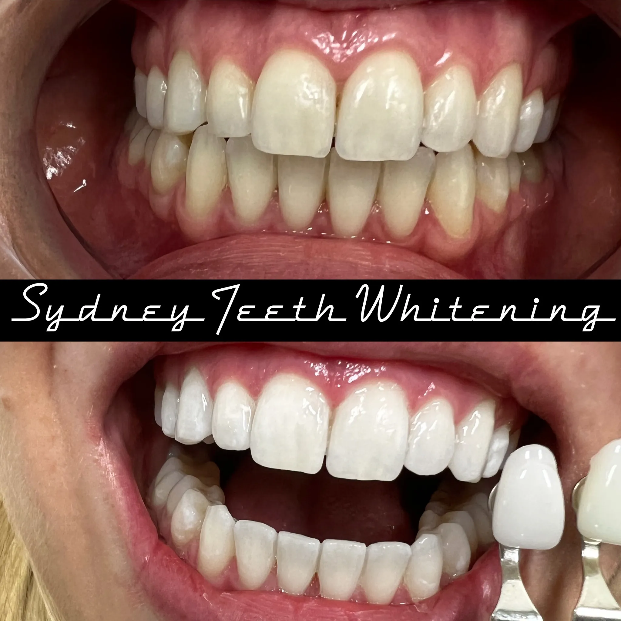 28313 sydney teeth whitening clinic