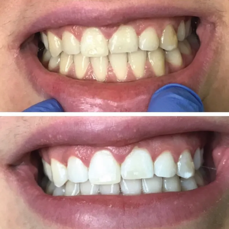28315 teeth whitening canterbury maintenance