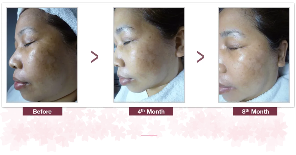 28318 skin pigmentation