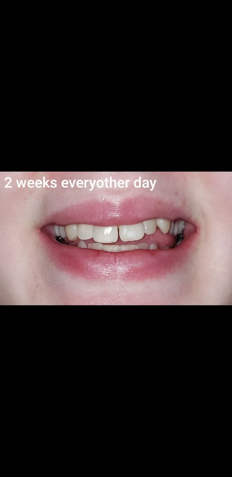 28321 teeth whitening process