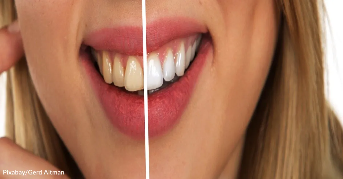 28331 teeth whitening oral health