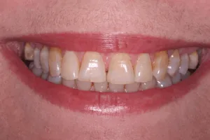 28334 teeth whitening stoke on trent aftercare