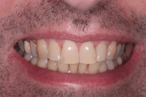 28334 teeth whitening stoke on trent maintaining smile