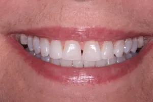 28334 teeth whitening stoke on trent whitening methods