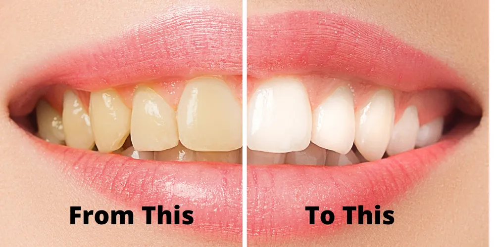 28337 teeth whitening maintenance