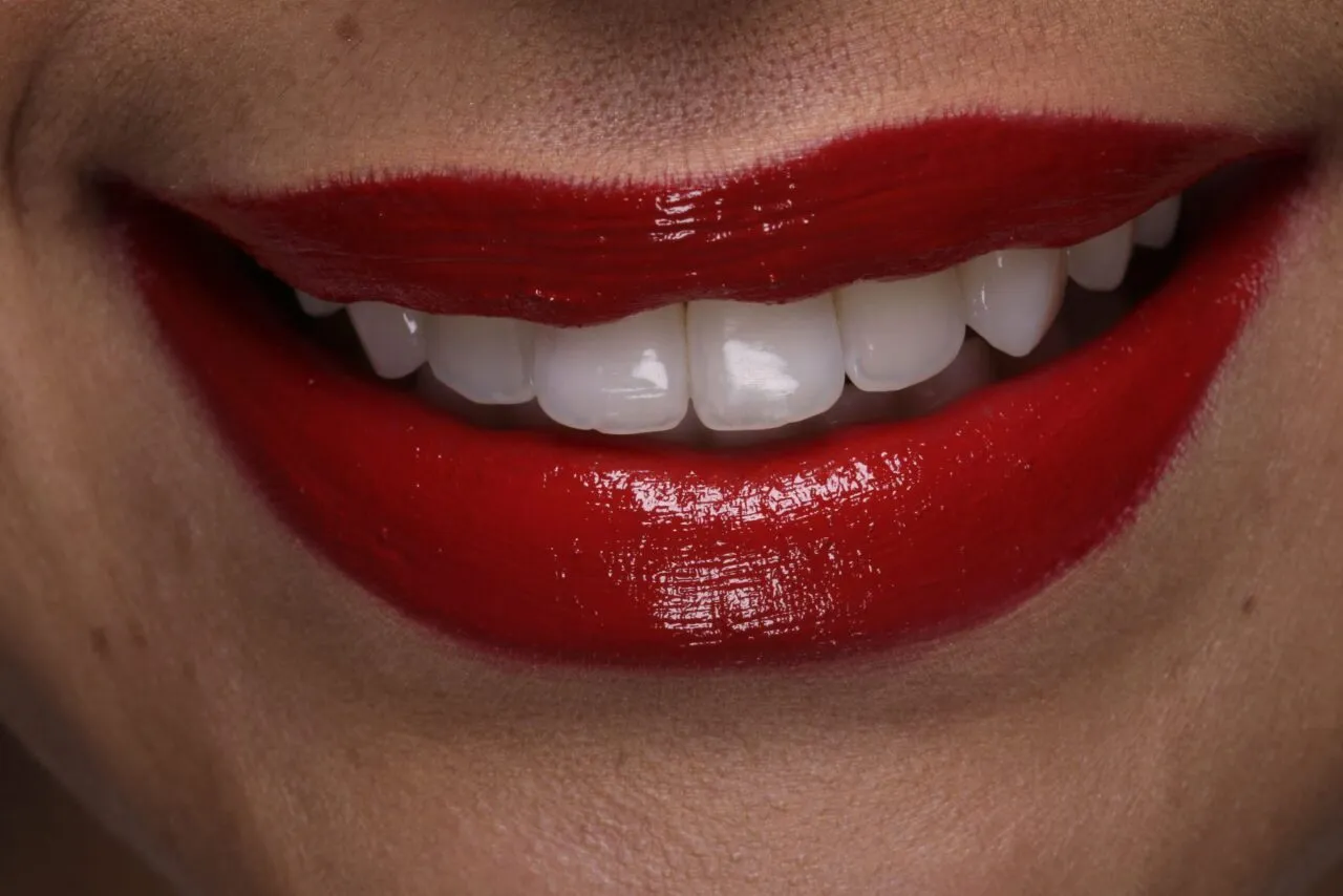 28340 teeth whitening process