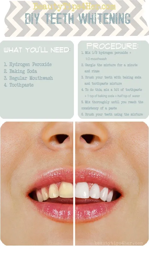 28341 teeth whitening prep 1