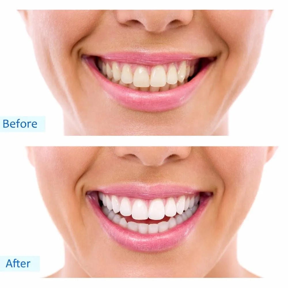 28342 teeth whitening park meadows mall process