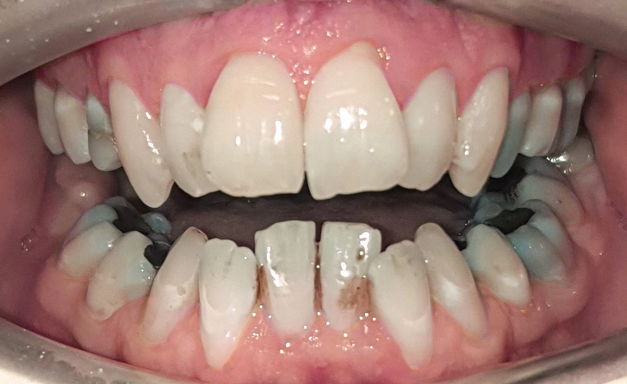 28343 oral hygiene during whitening