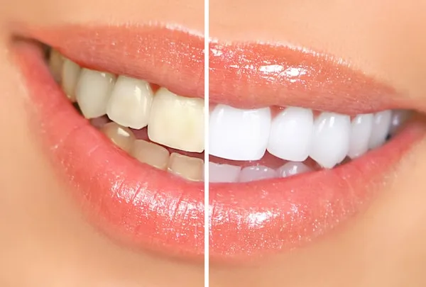 28344 sensitive teeth after whitening 1
