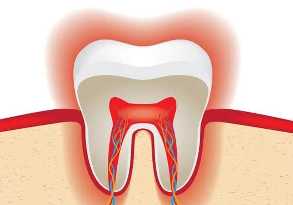 28344 sensitive teeth after whitening 4