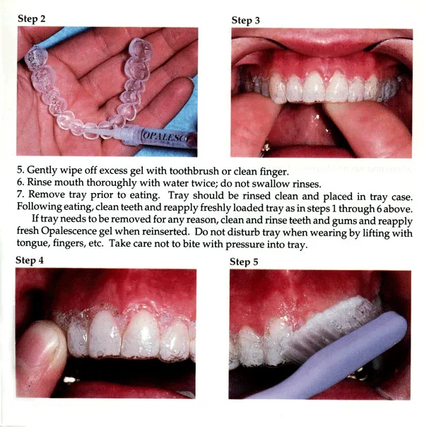 /img/28345-teeth-whitening-results.webp