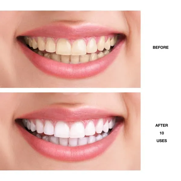 28347 teeth whitening results