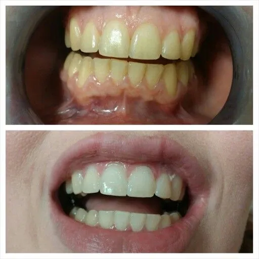 28351 teeth whitening meridian id image 3