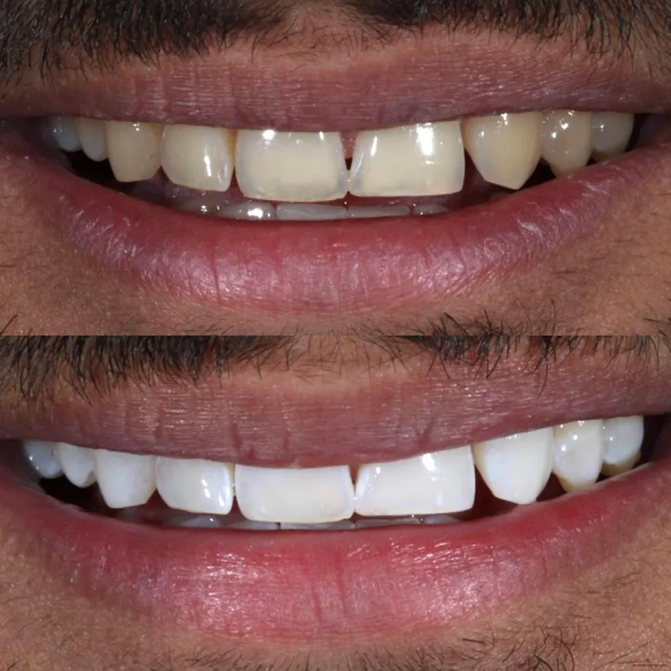 28351 teeth whitening meridian id image 4