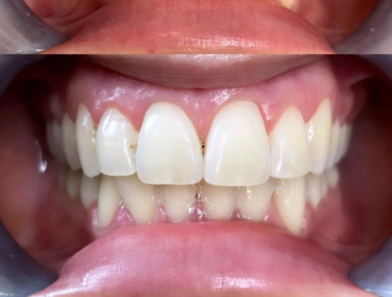 28351 teeth whitening meridian id image 5