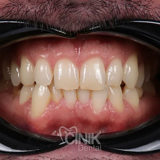 28351 teeth whitening meridian id image 6