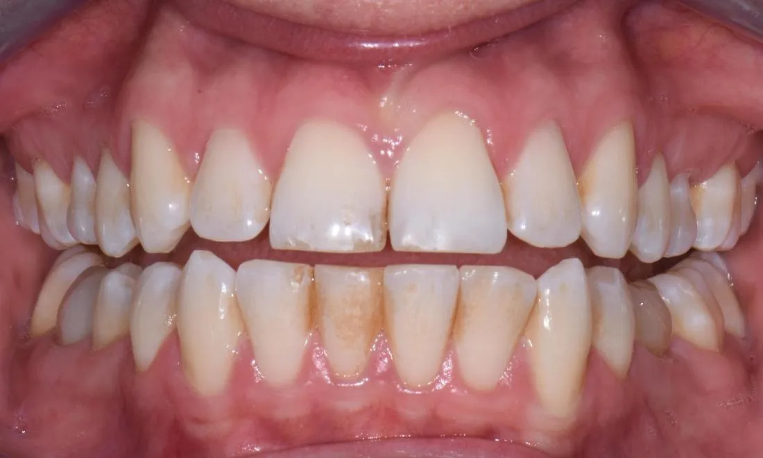 28353 teeth whitening results
