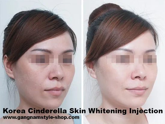 28357 cinderella injection before after