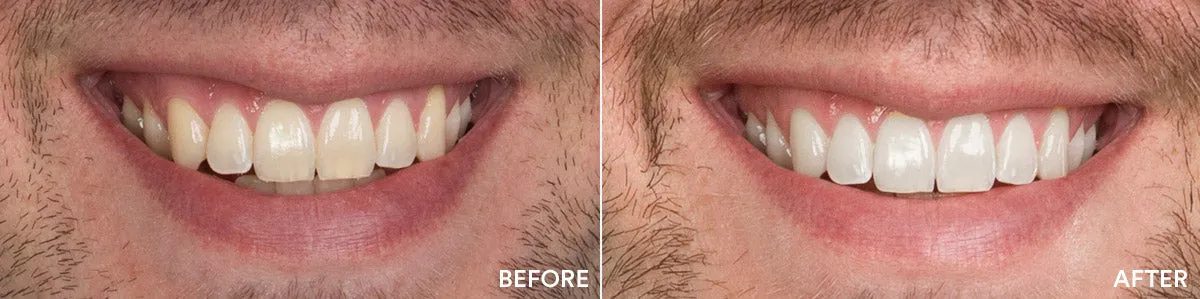 28364 teeth whitening gungahlin dentist consultation