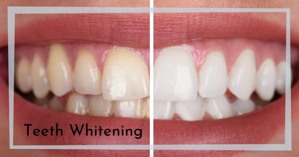 28364 teeth whitening gungahlin professional treatment