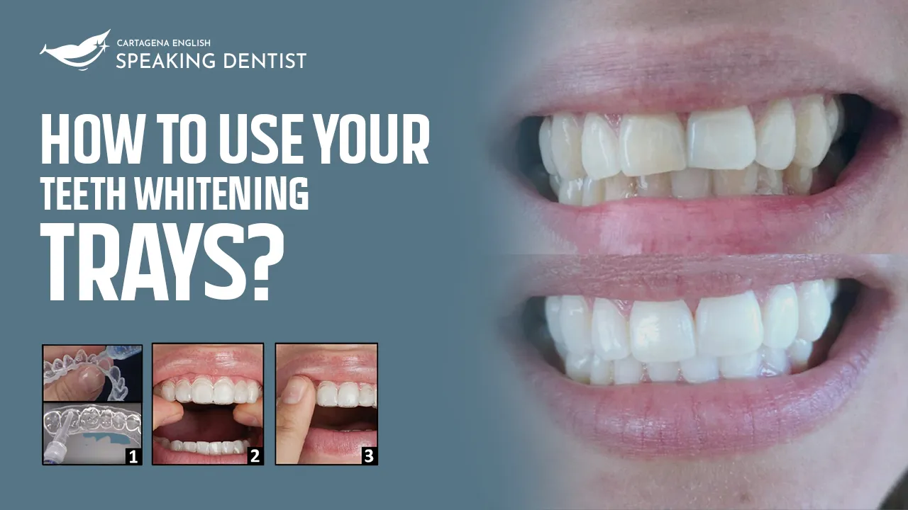 28365 teeth whitening maintenance