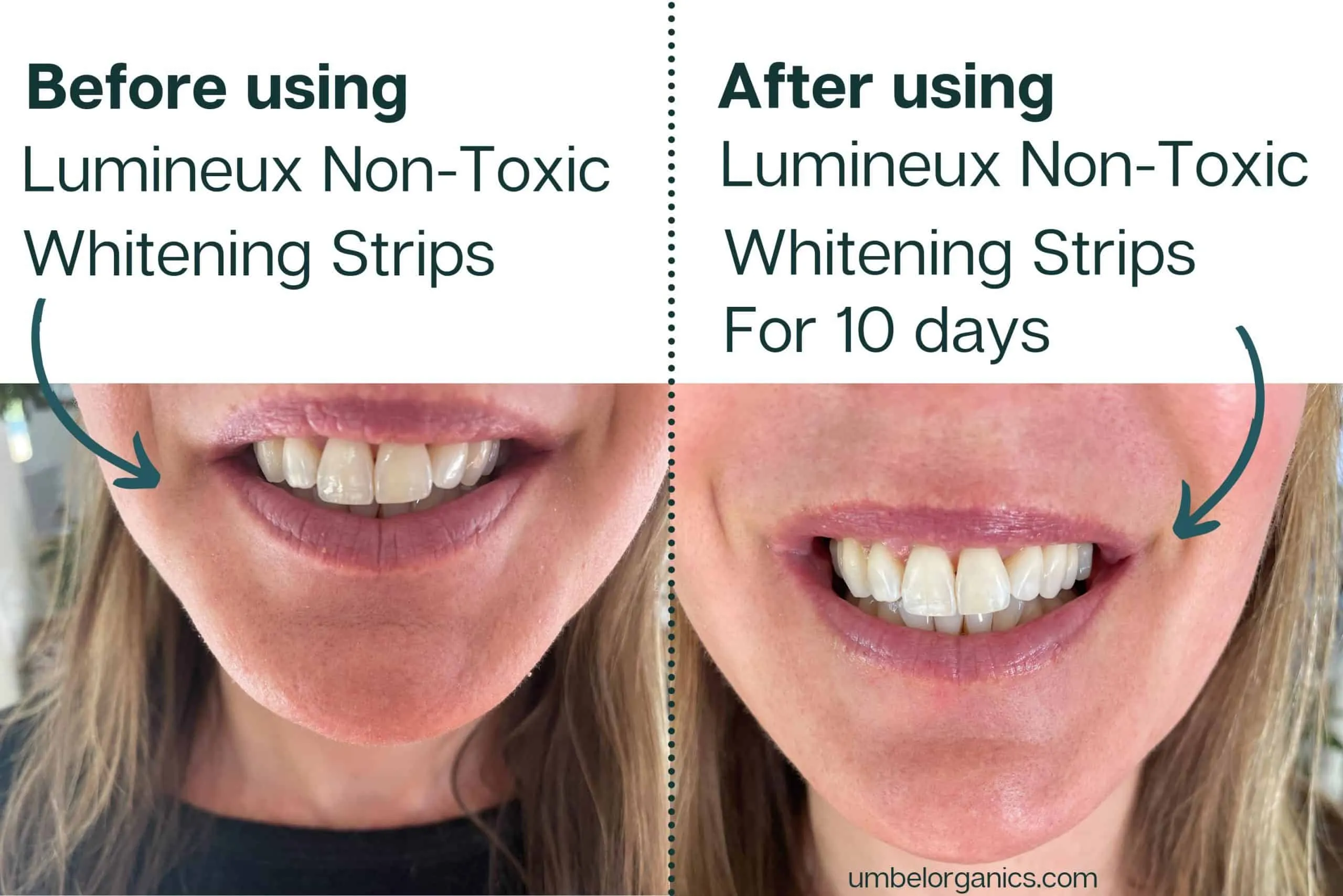 28372 crest whitening strips before after