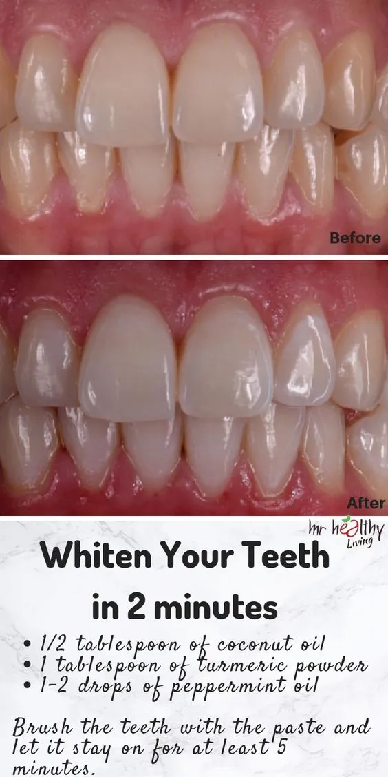 28373 whitening strips application