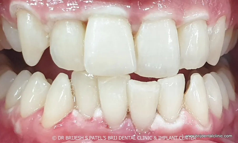 28378 red swollen gums