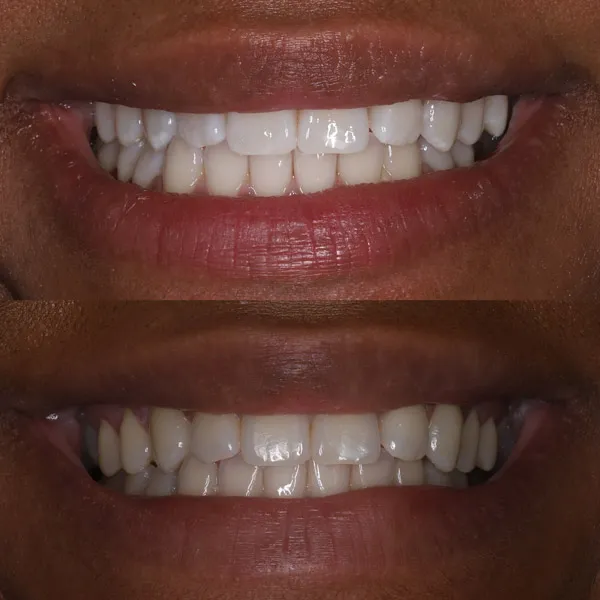 28380 teeth whitening procedure
