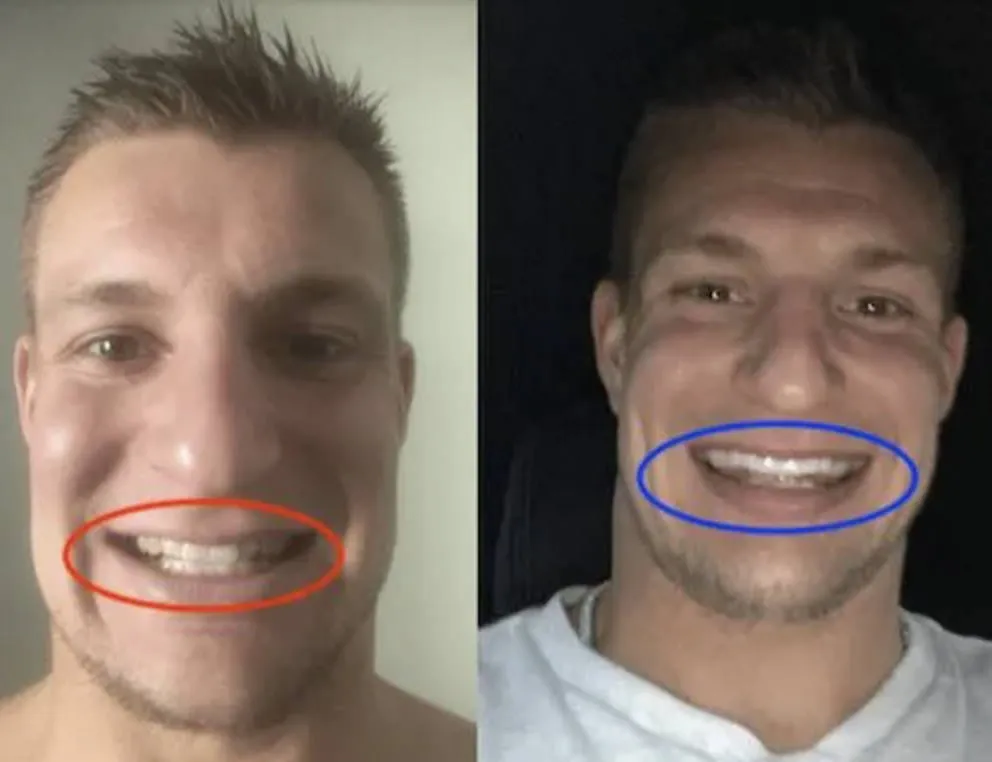 28382 teeth cleaning