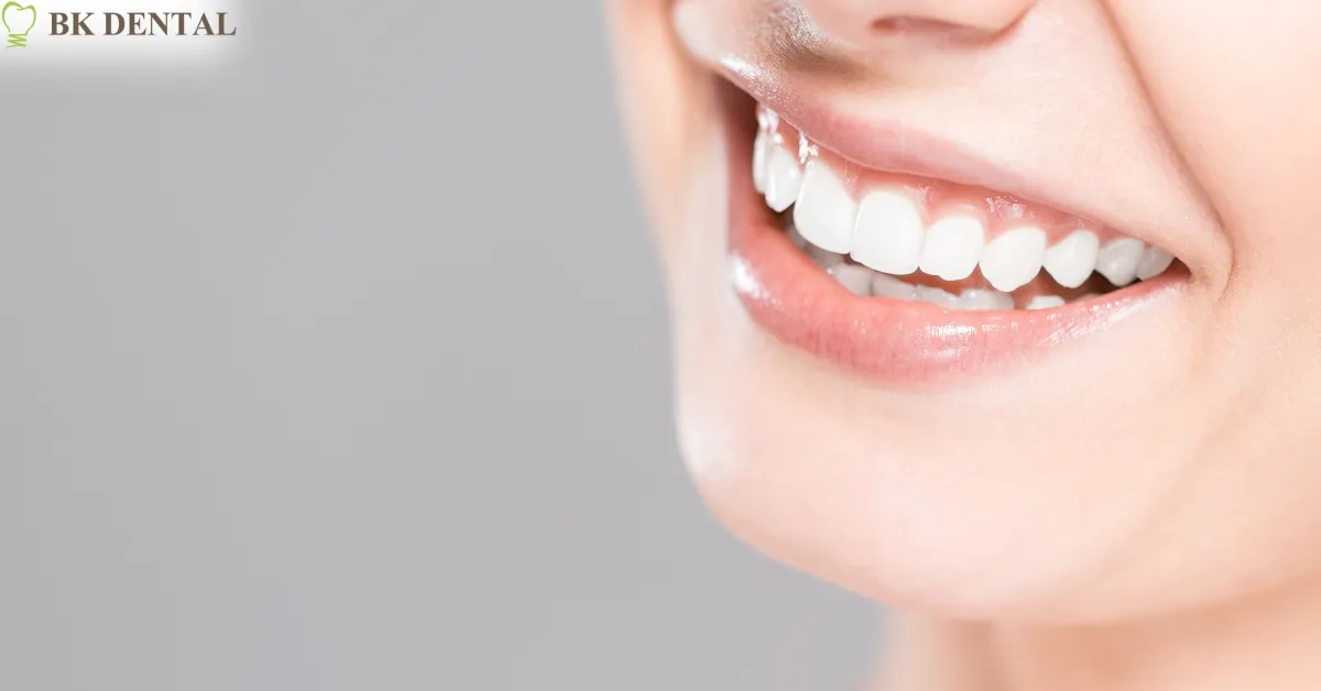 28387 take home teeth whitening kits