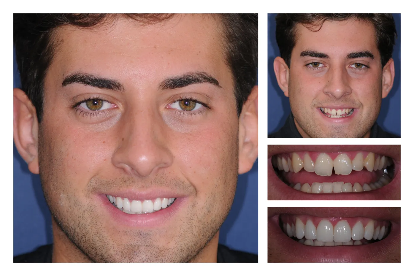 28401 laser teeth whitening essex 5