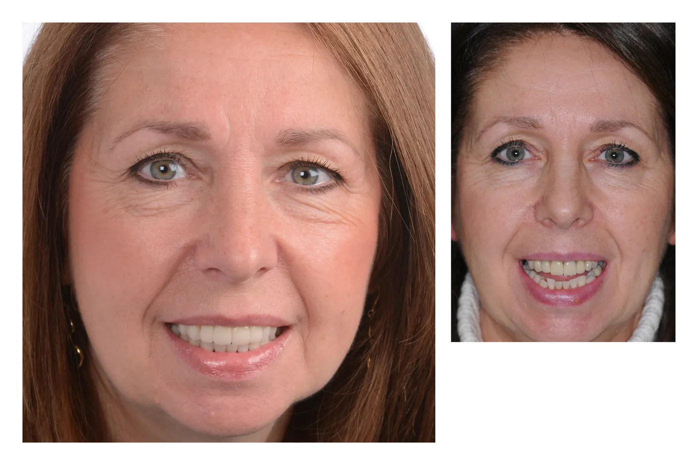 /img/28401-laser-teeth-whitening-essex-7.webp