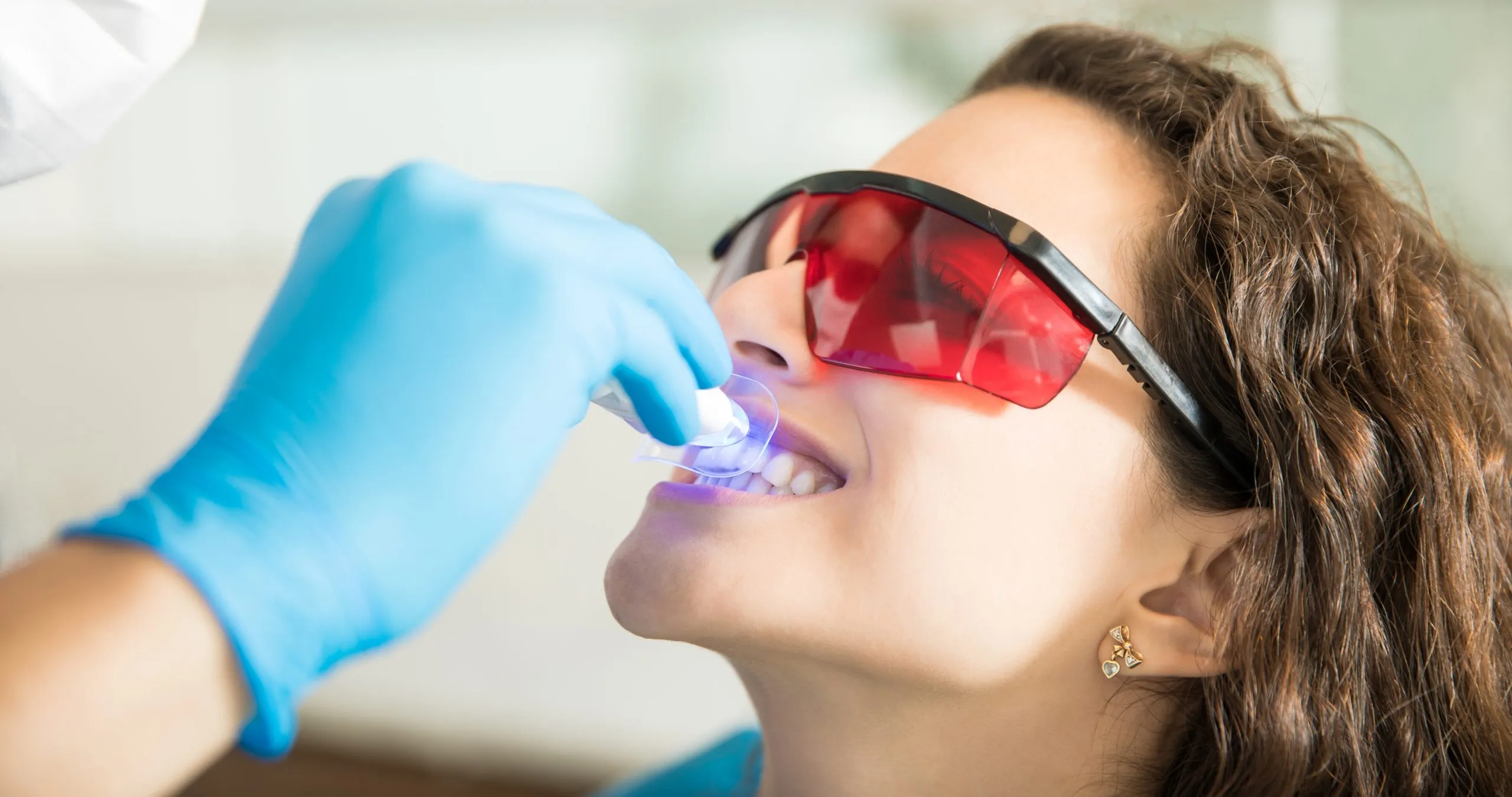 28403 teeth whitening barcelona before after