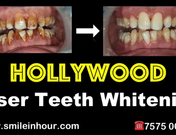 28404 laser whitening procedure